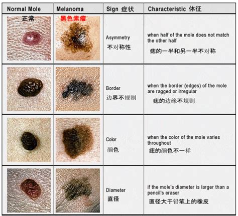 微凸的痣|一图读懂：什么样的痣易癌变？